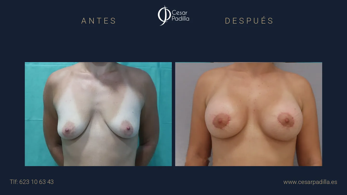 Antes y después de mastopexia areolar, caso 9