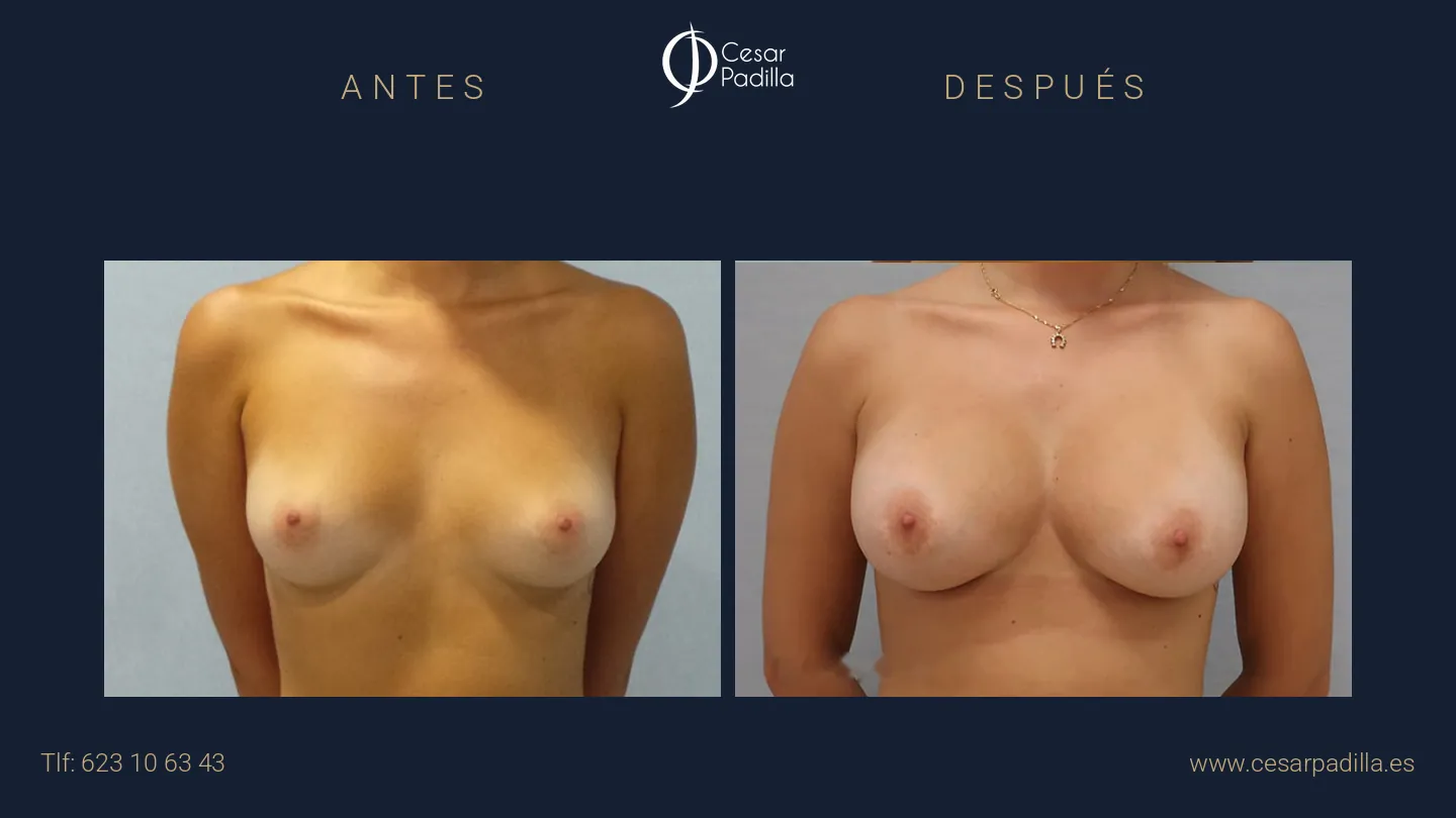 Antes y después de aumento de pecho