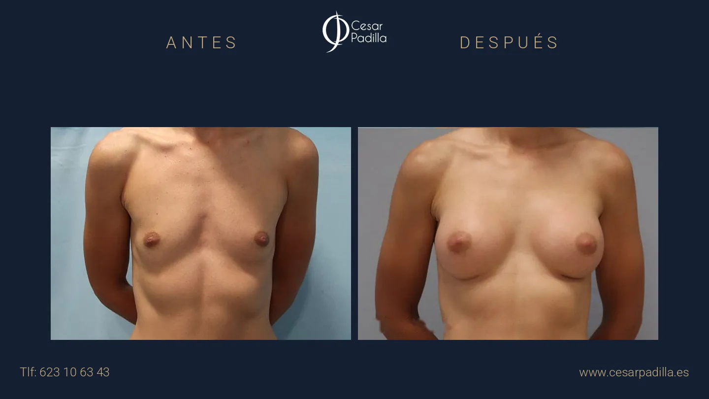 Antes y después de aumento de pecho, caso 10