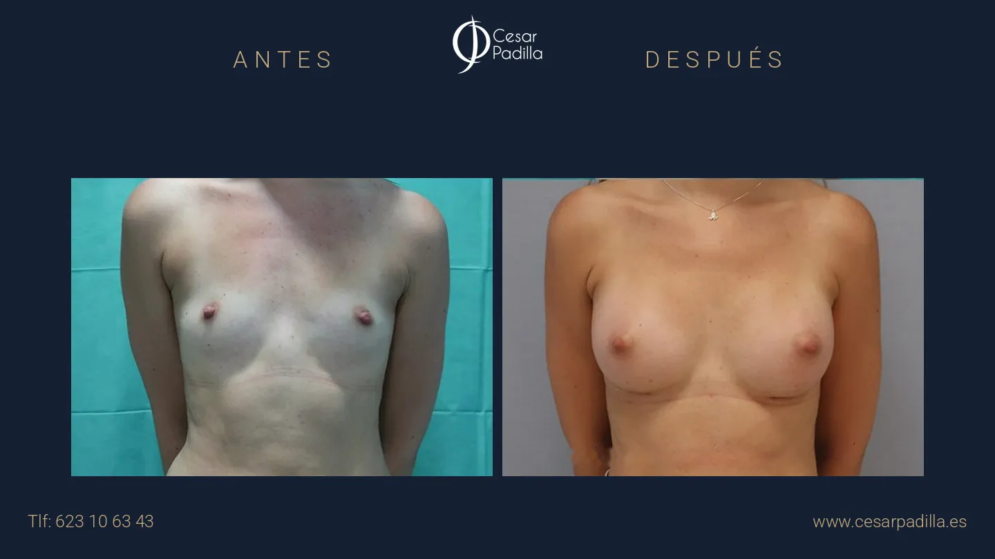 Antes y después de aumento de pecho, caso 11