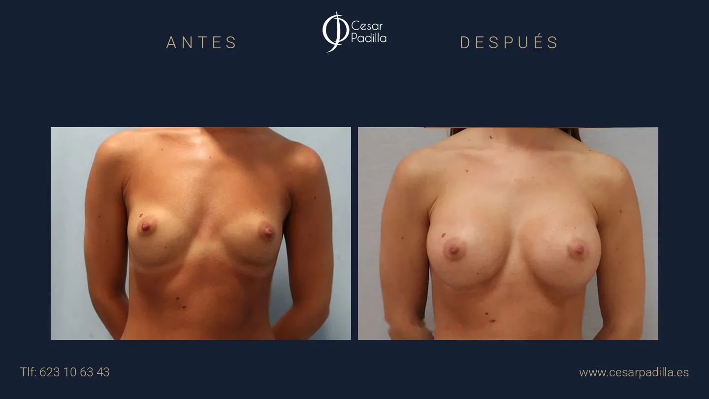 Antes y después de aumento de pecho, caso 13