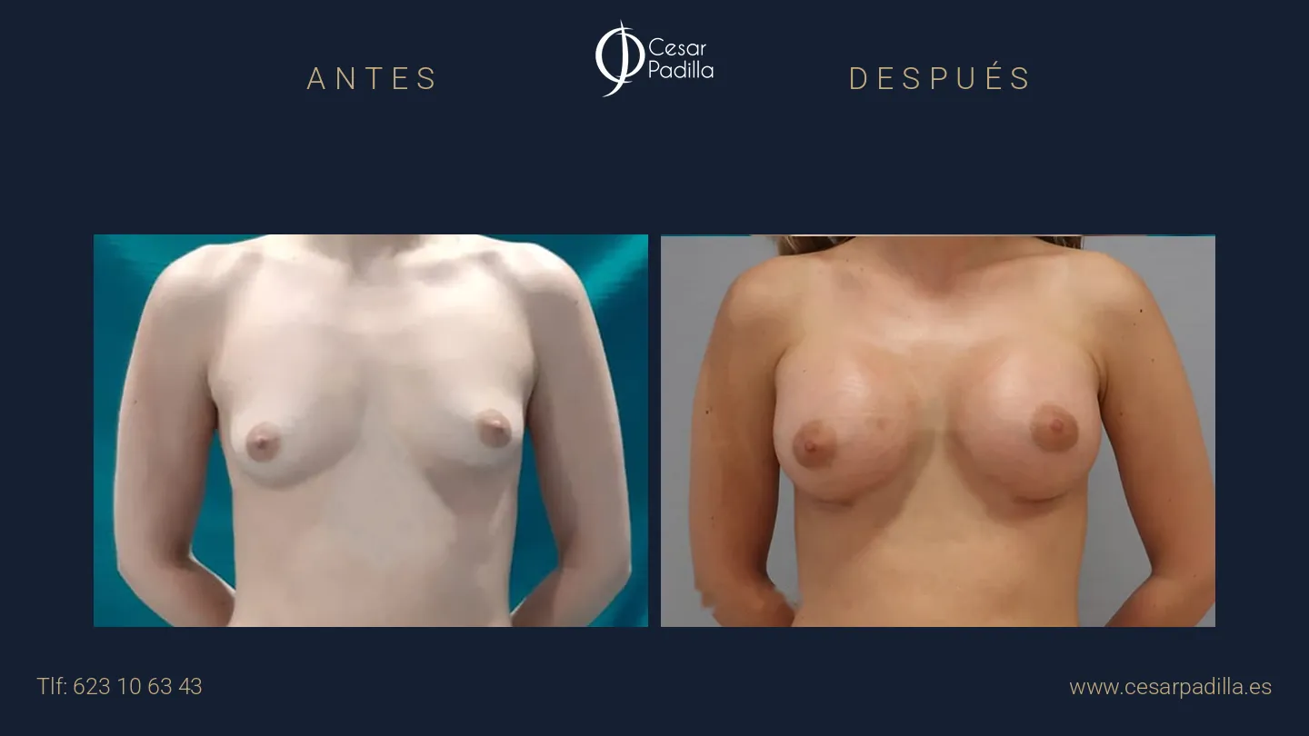 Antes y después de aumento de pecho, caso 14