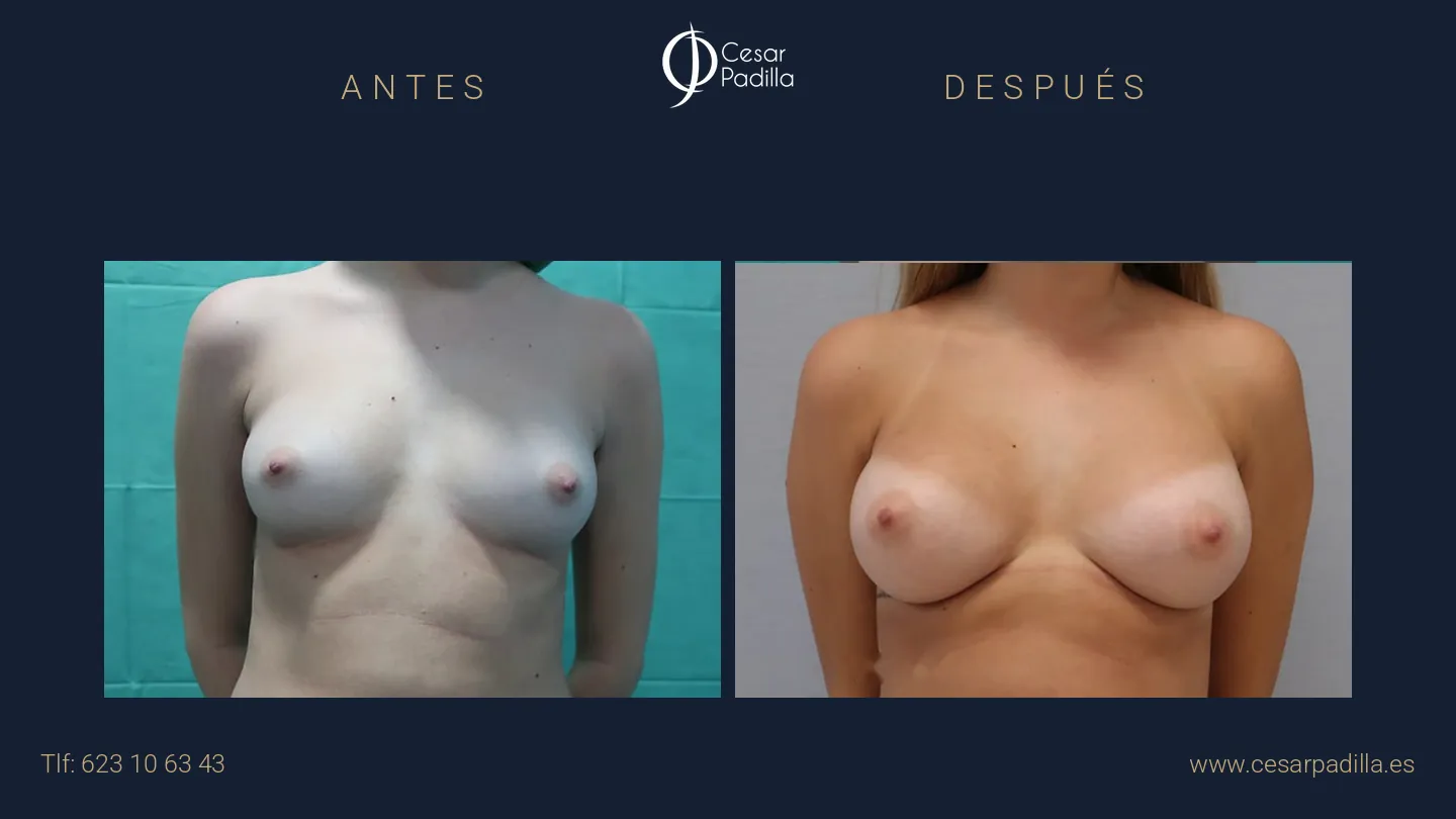 Antes y después de aumento de pecho, caso 16