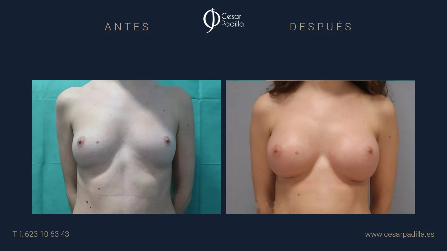 Antes y después de aumento de pecho, caso 17