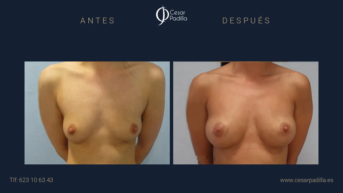 Antes y después de Aumento de pecho