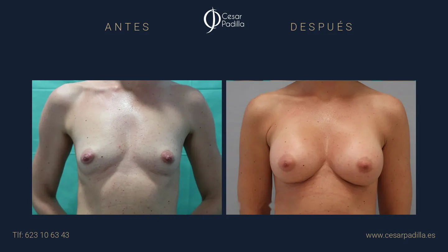 Antes y después de aumento de pecho, caso 20
