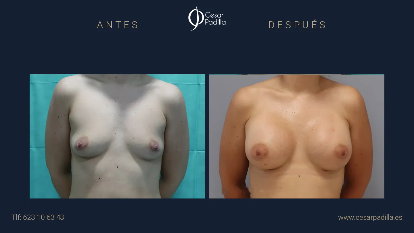 Antes y después de aumento de pecho, caso 21