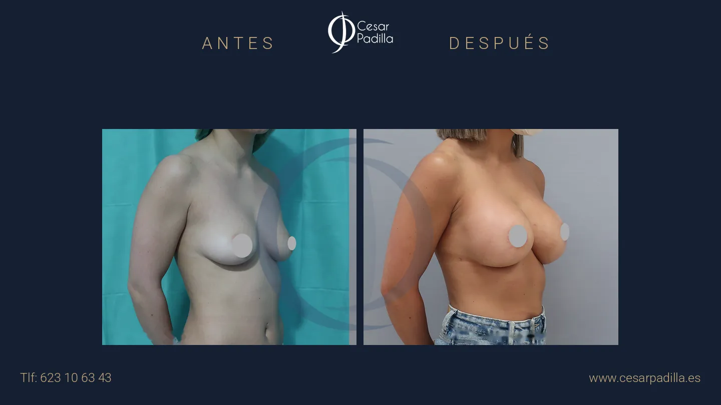 Antes y después de aumento de pecho, caso 25