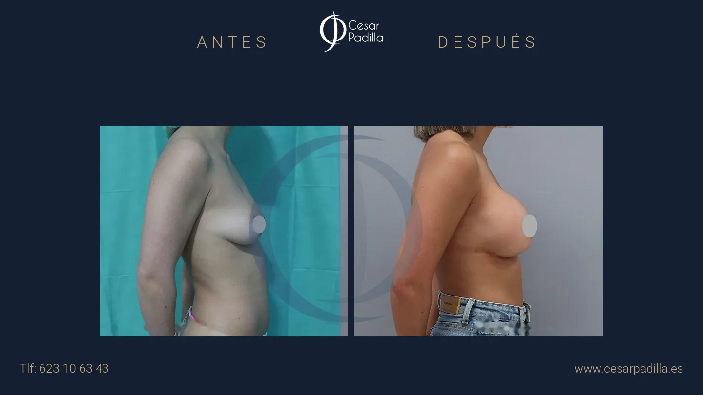 Antes y después de aumento de pecho, caso 26