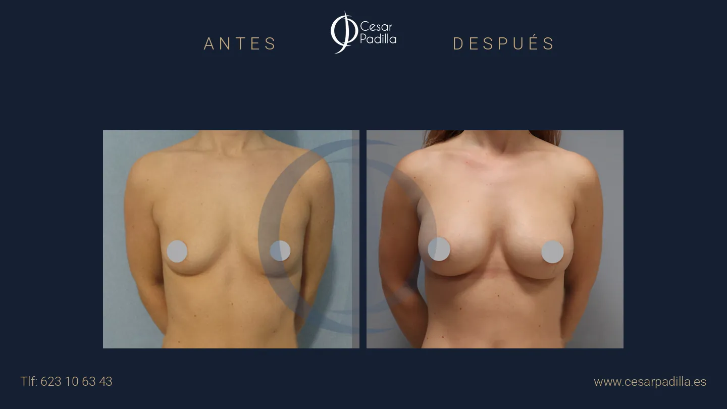 Antes y después de aumento de pecho, caso 27