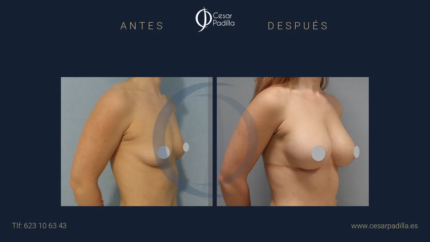Antes y después de aumento de pecho, caso 28