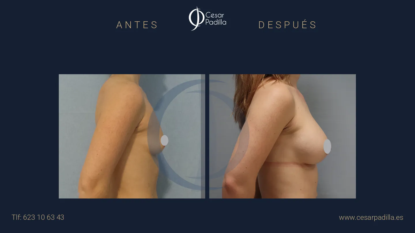 Antes y después de aumento de pecho, caso 29