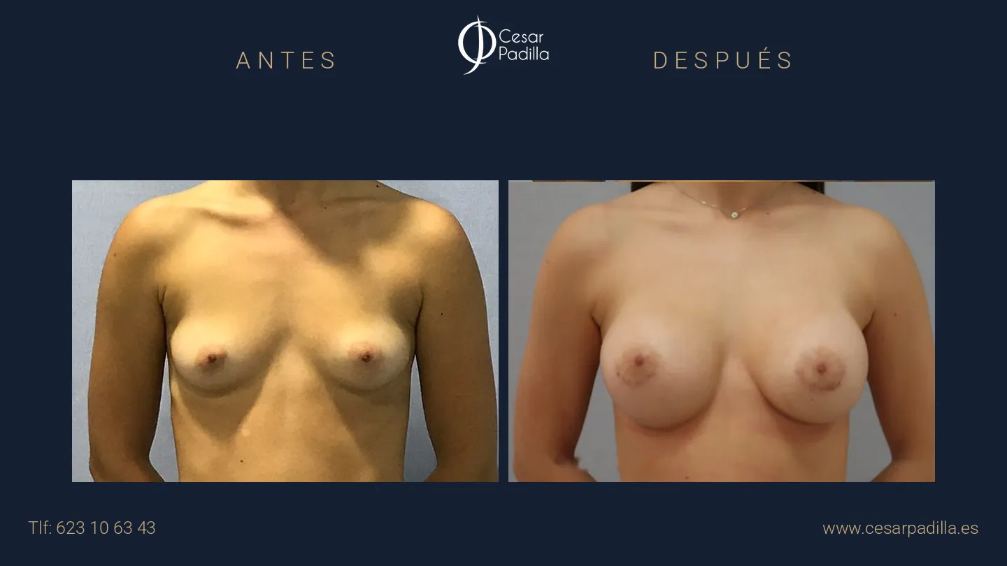 Antes y después de Aumento de pecho