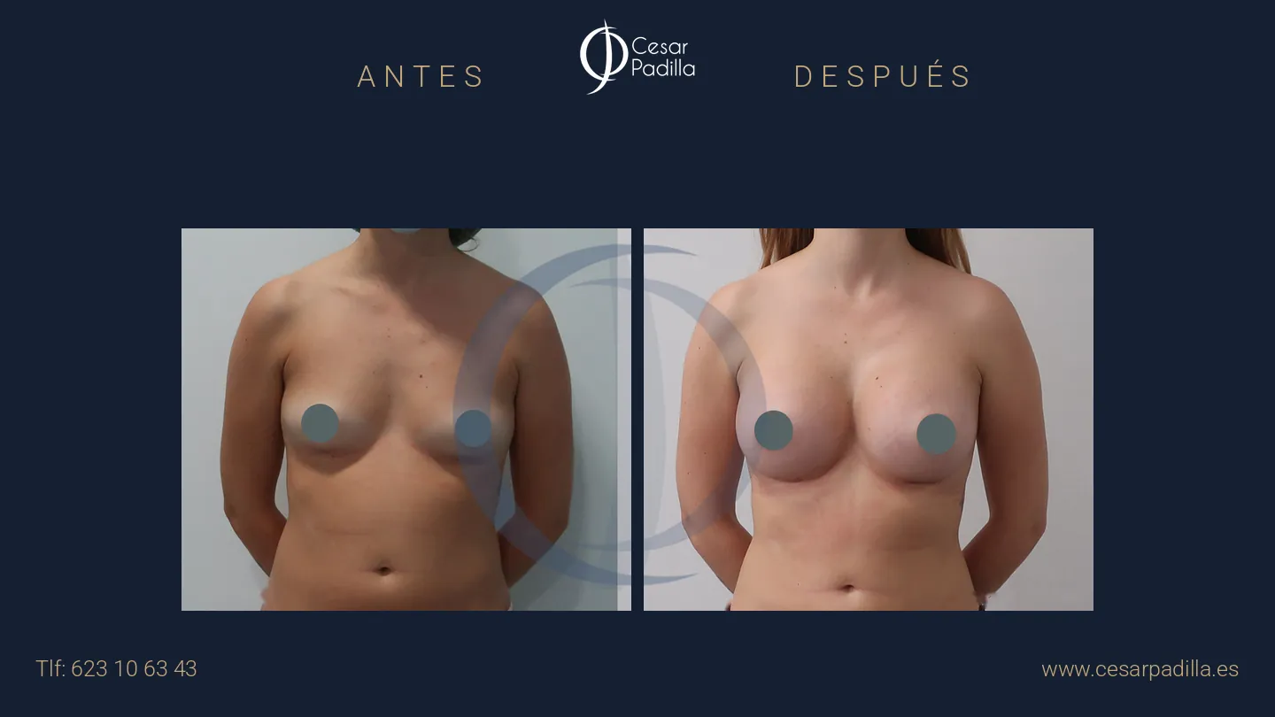 Antes y después de aumento de pecho, caso 30