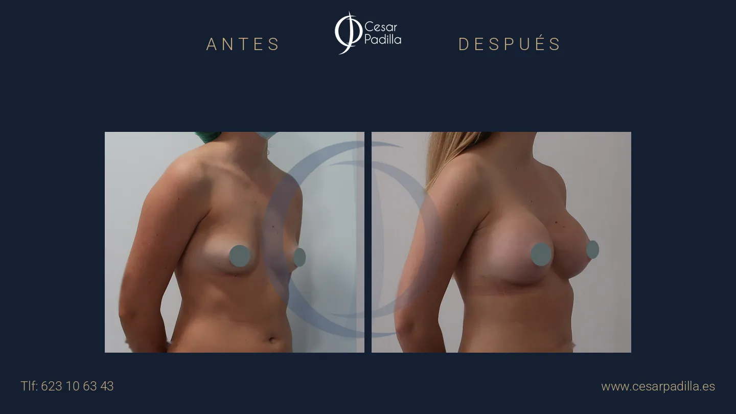 Antes y después de aumento de pecho, caso 31
