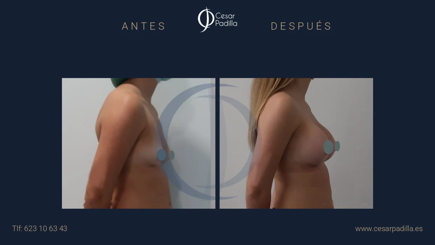 Antes y después de aumento de pecho, caso 32