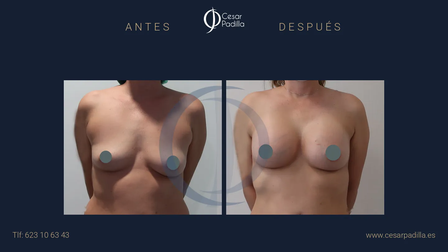 Antes y después de aumento de pecho, caso 33