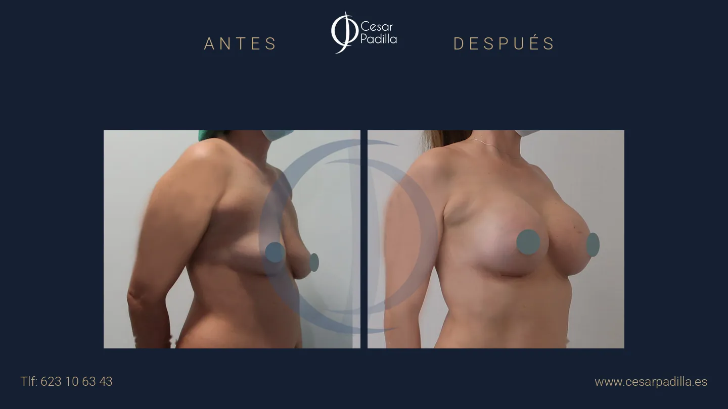 Antes y después de aumento de pecho, caso 34
