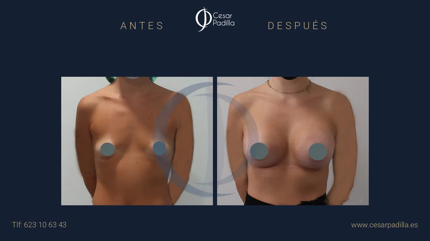Antes y después de aumento de pecho, caso 36