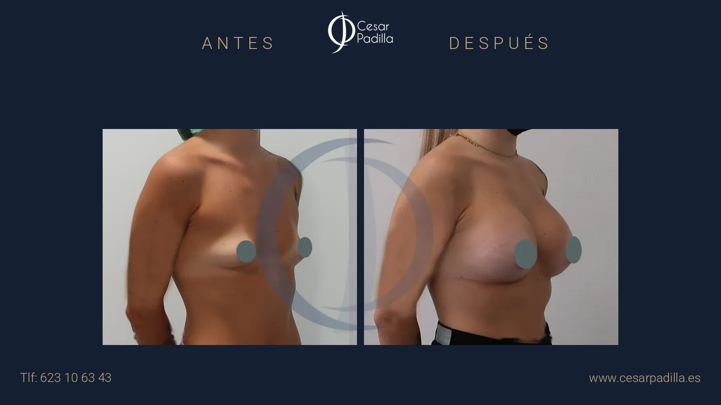 Antes y después de aumento de pecho, caso 37