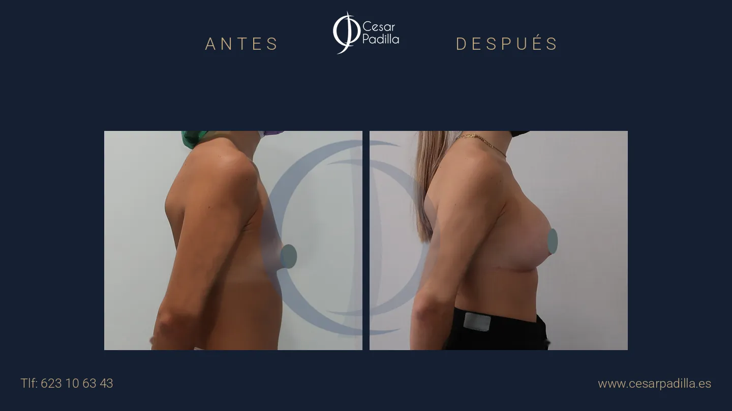 Antes y después de aumento de pecho, caso 38
