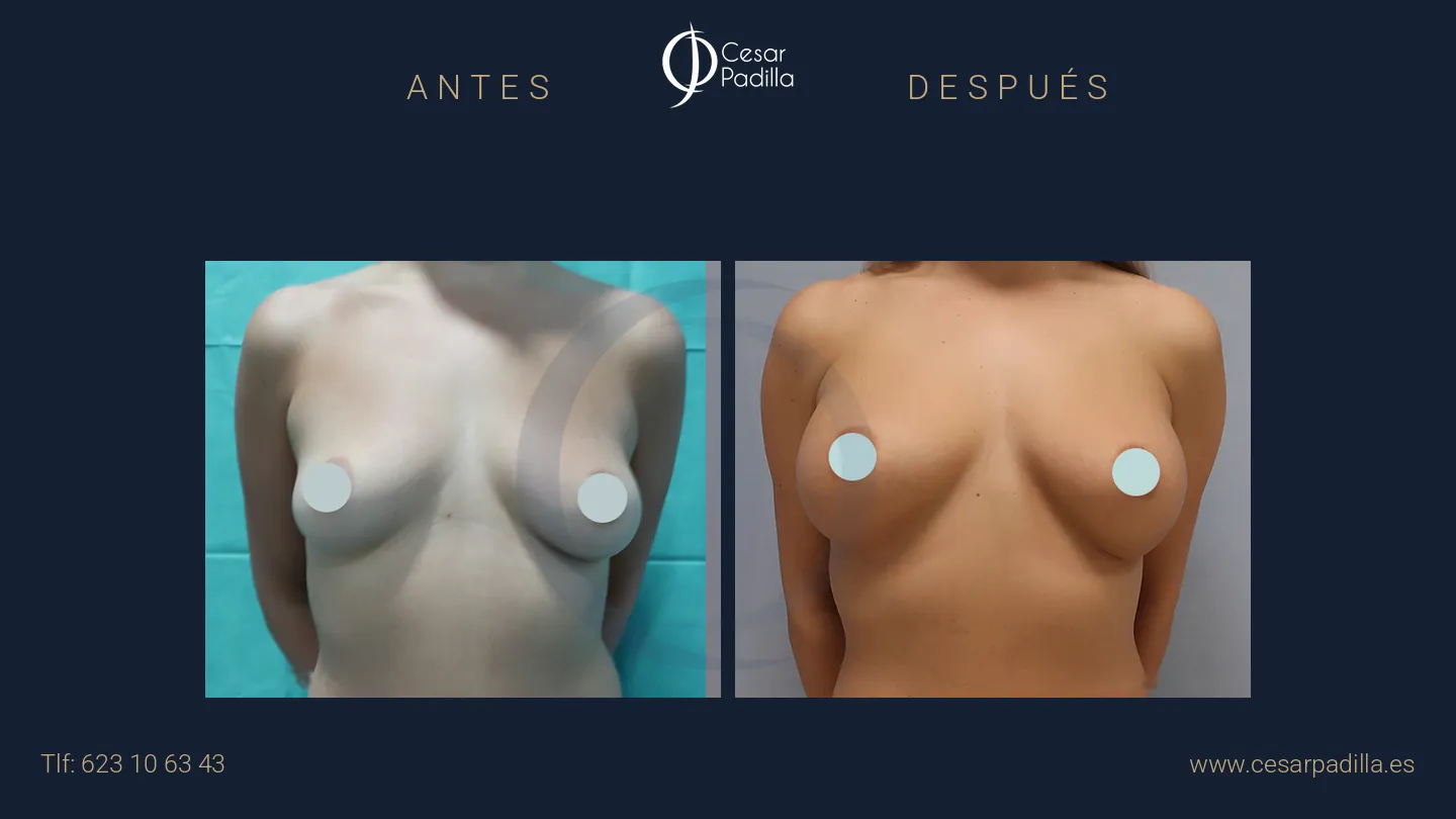 Antes y después de aumento de pecho, caso 39