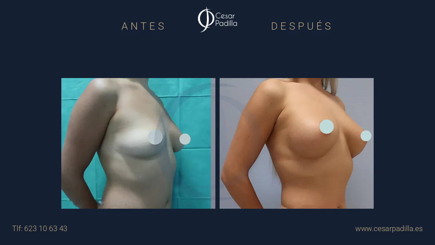 Antes y después de aumento de pecho, caso 40