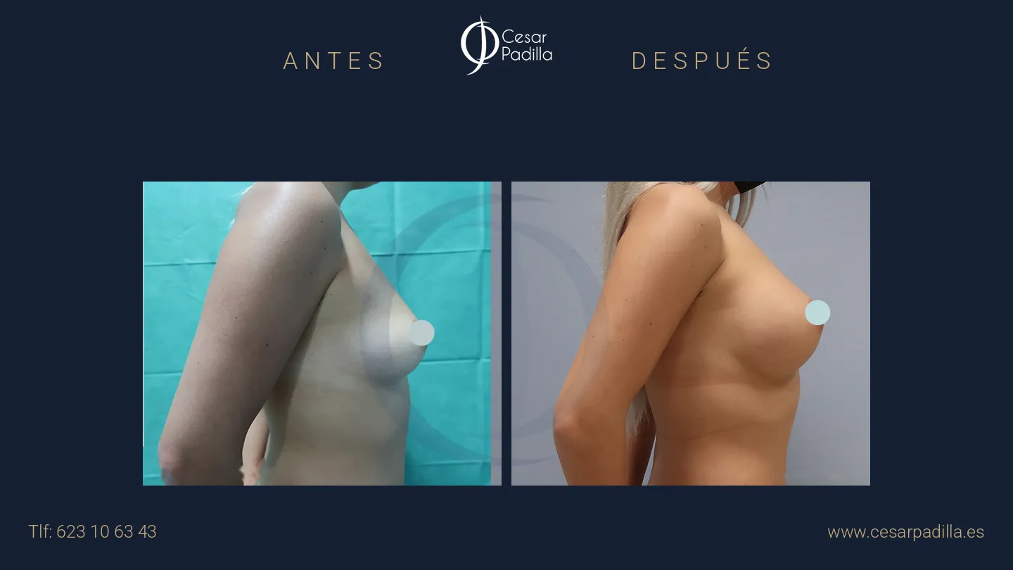 Antes y después de aumento de pecho, caso 41