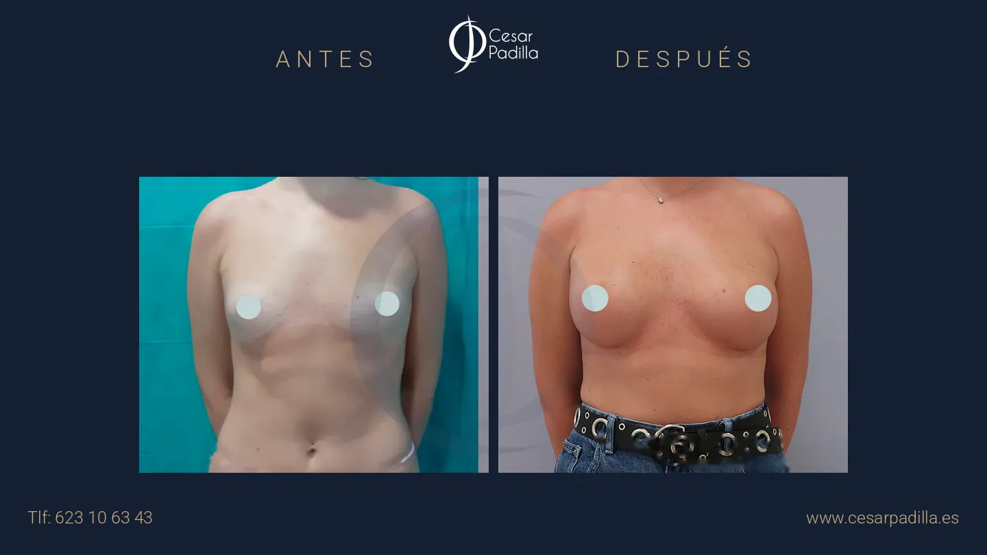 Antes y después de aumento de pecho, caso 42
