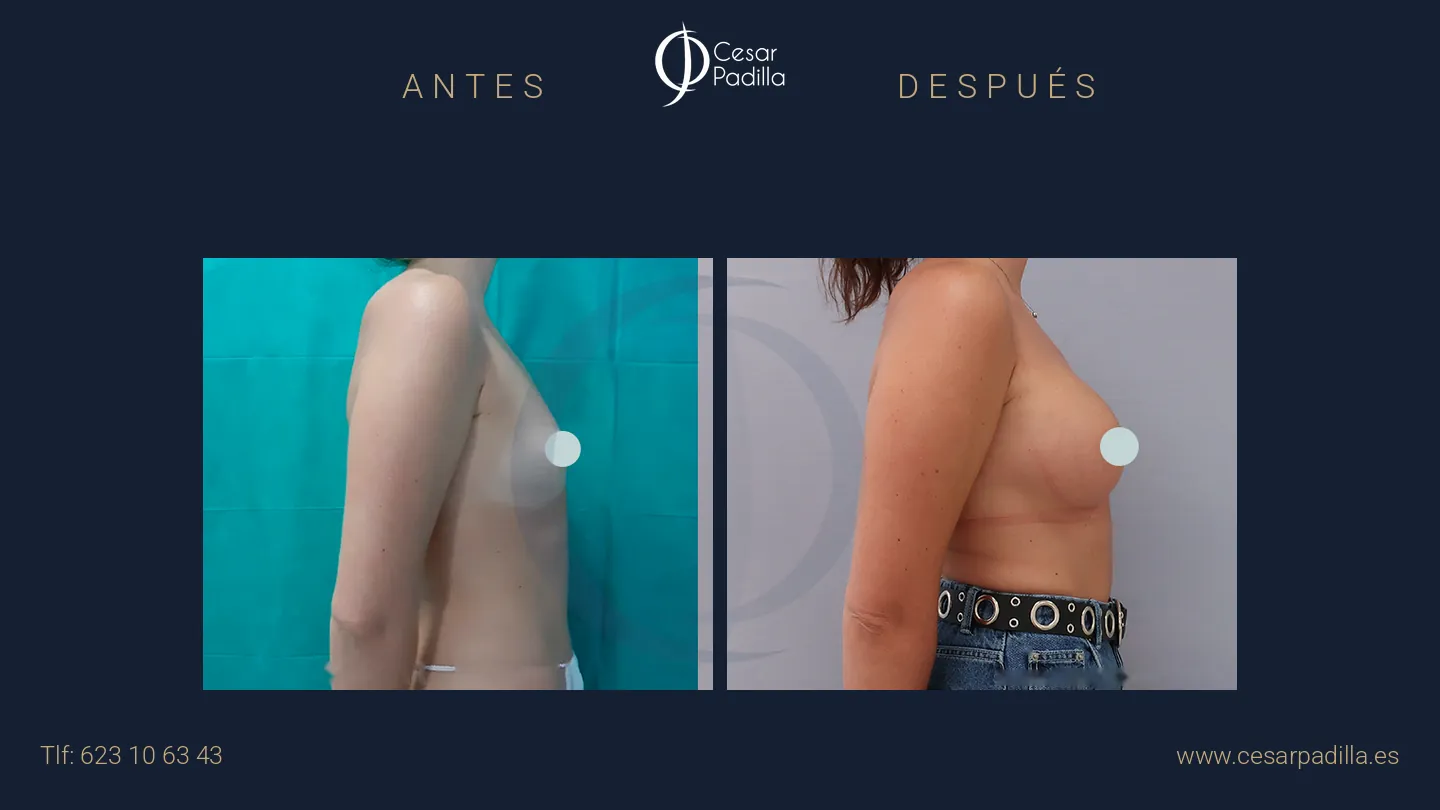 Antes y después de aumento de pecho, caso 43