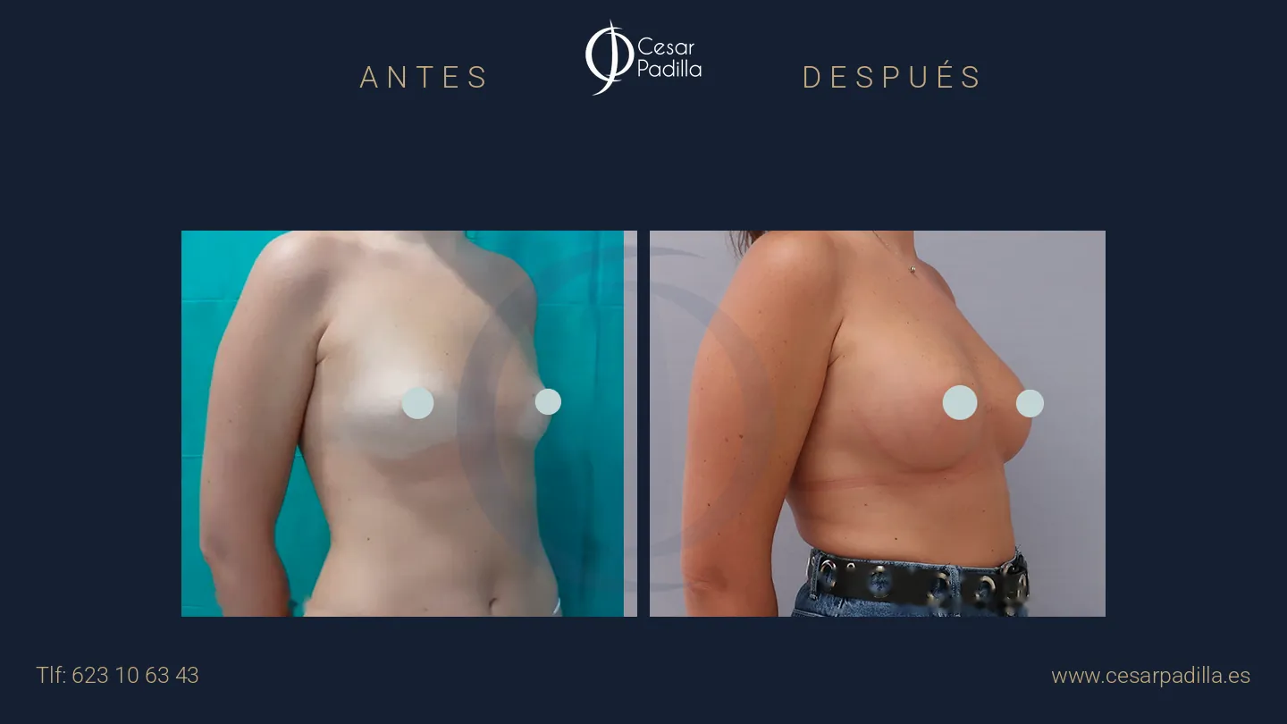 Antes y después de aumento de pecho, caso 44