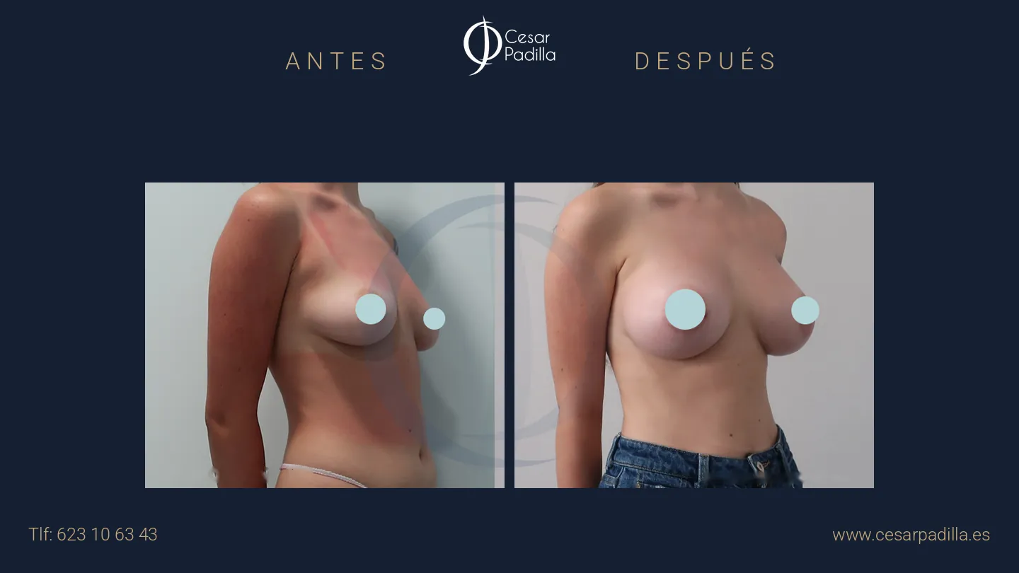 Antes y después de aumento de pecho, caso 46