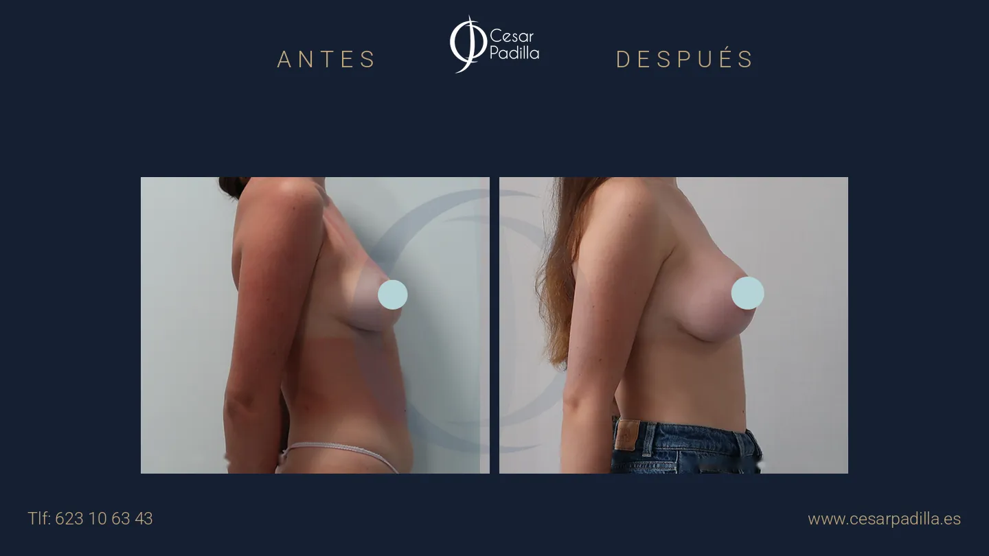 Antes y después de aumento de pecho, caso 47