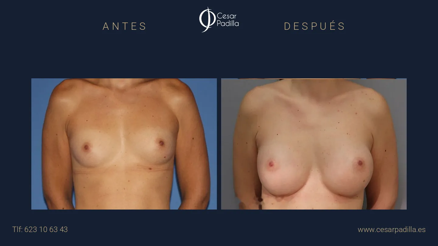 Antes y después de Aumento de pecho
