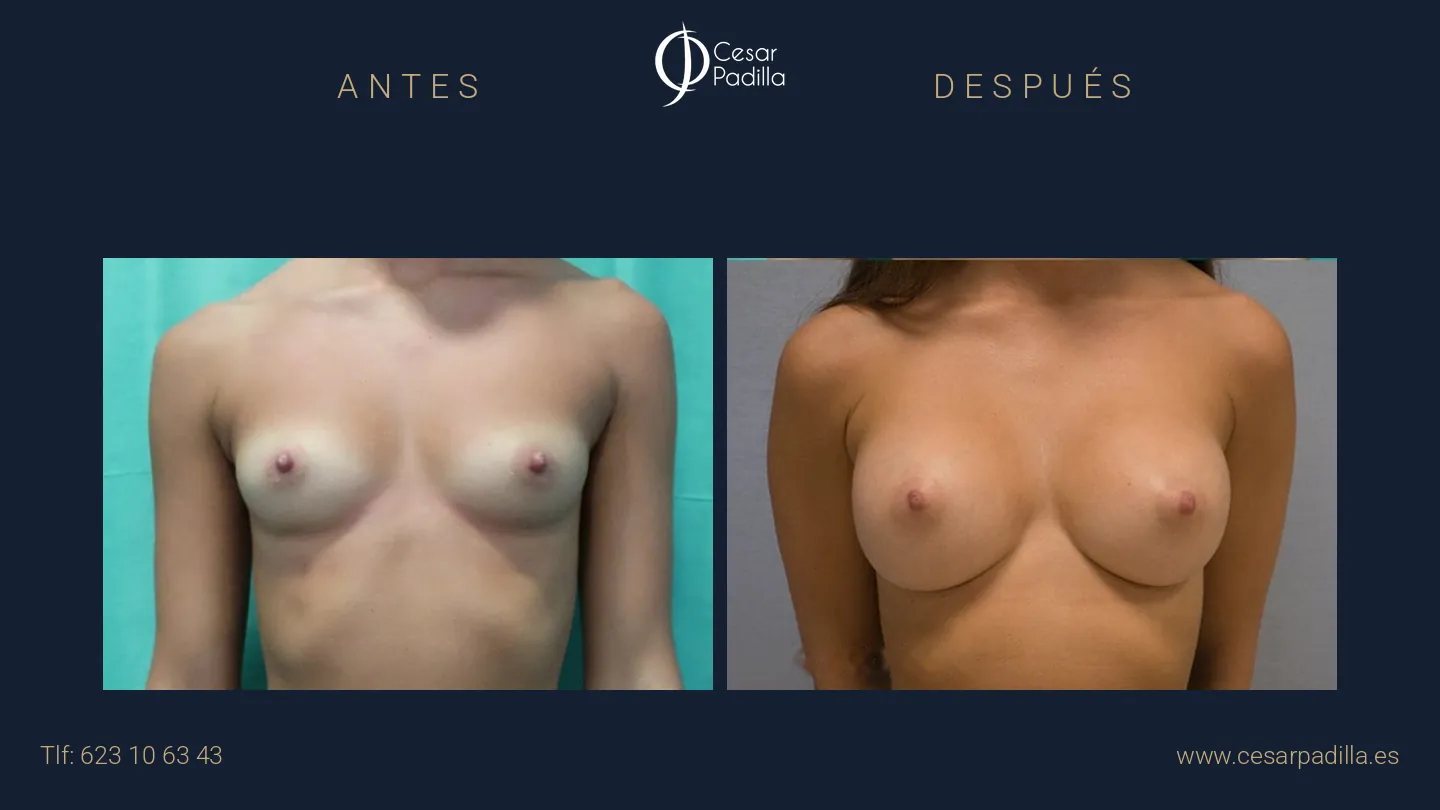 Antes y después de Aumento de pecho