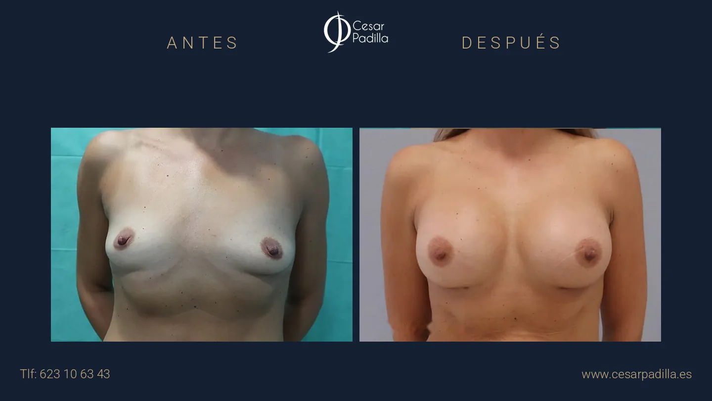 Antes y después de Aumento de pecho