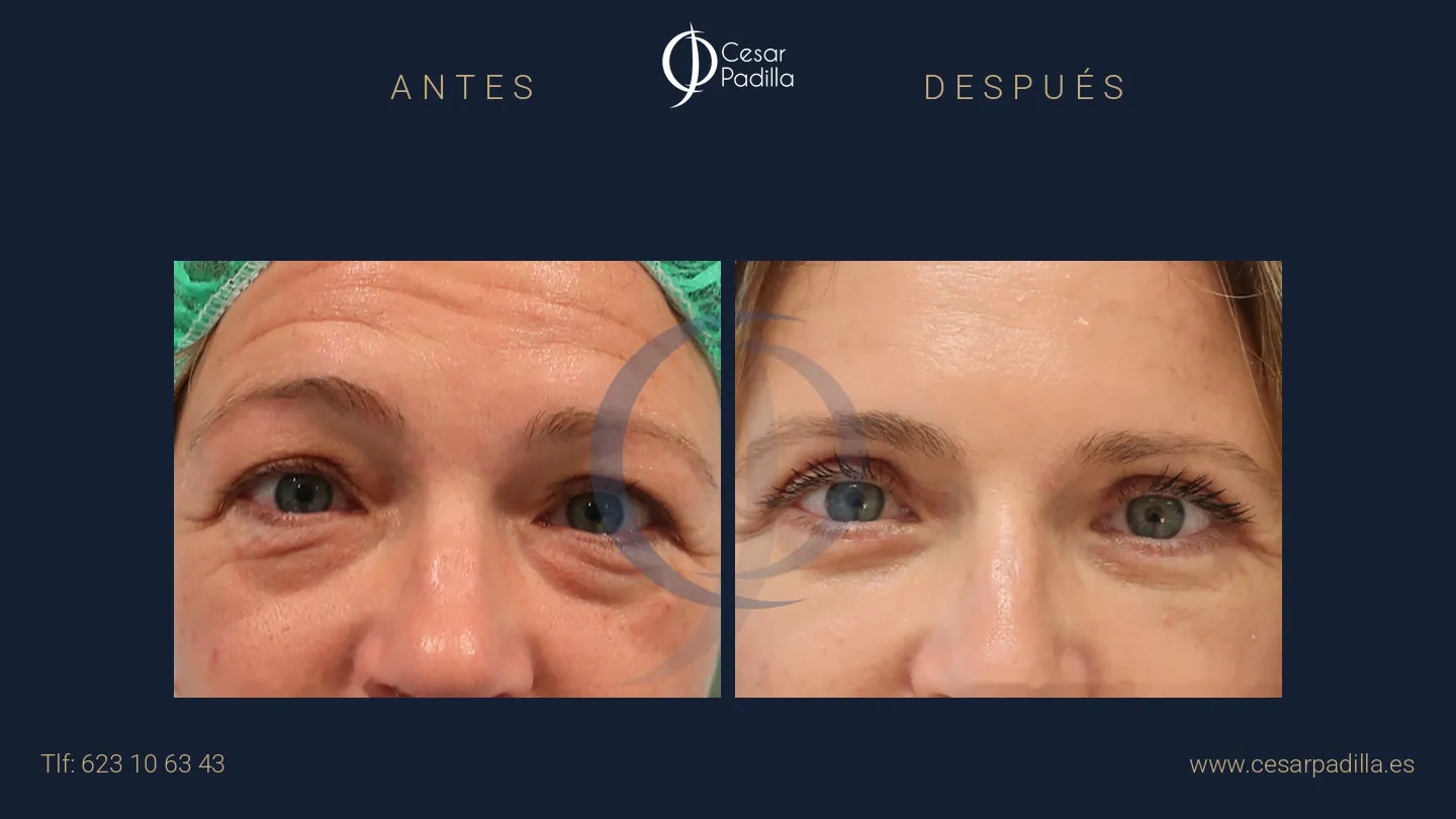 Antes y después de blefaroplastia, caso 1