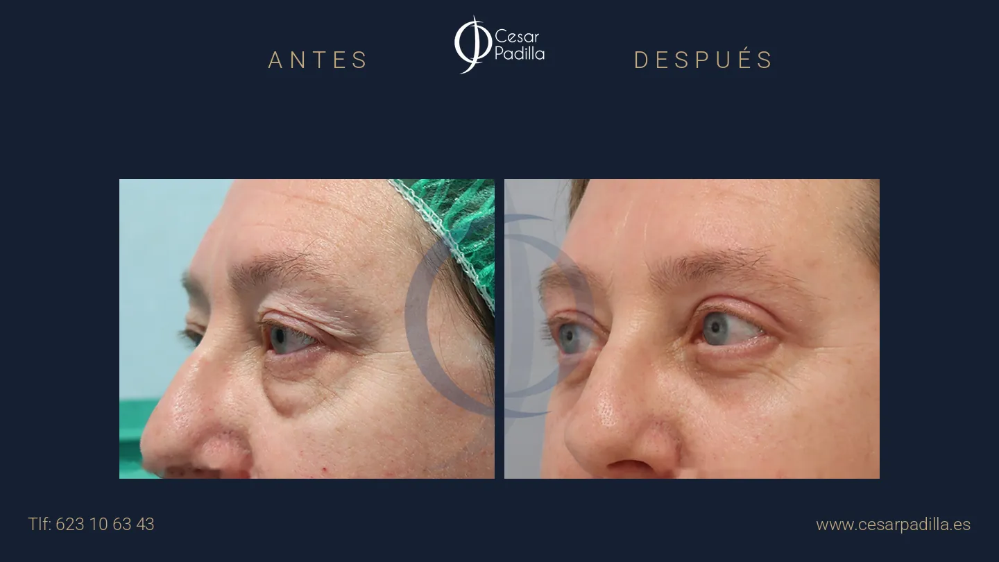 Antes y después de blefaroplastia, caso 10