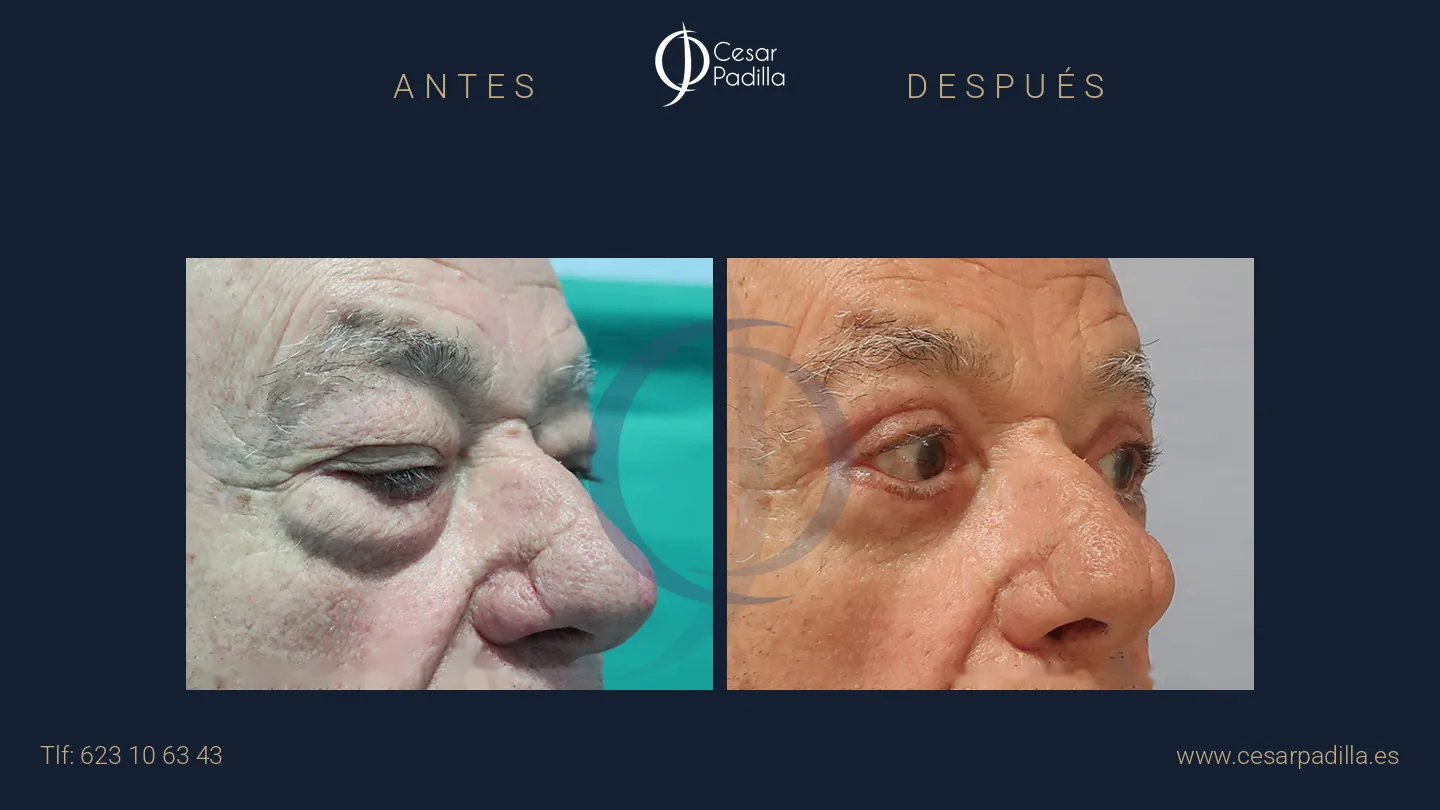 Antes y después de blefaroplastia, caso 11