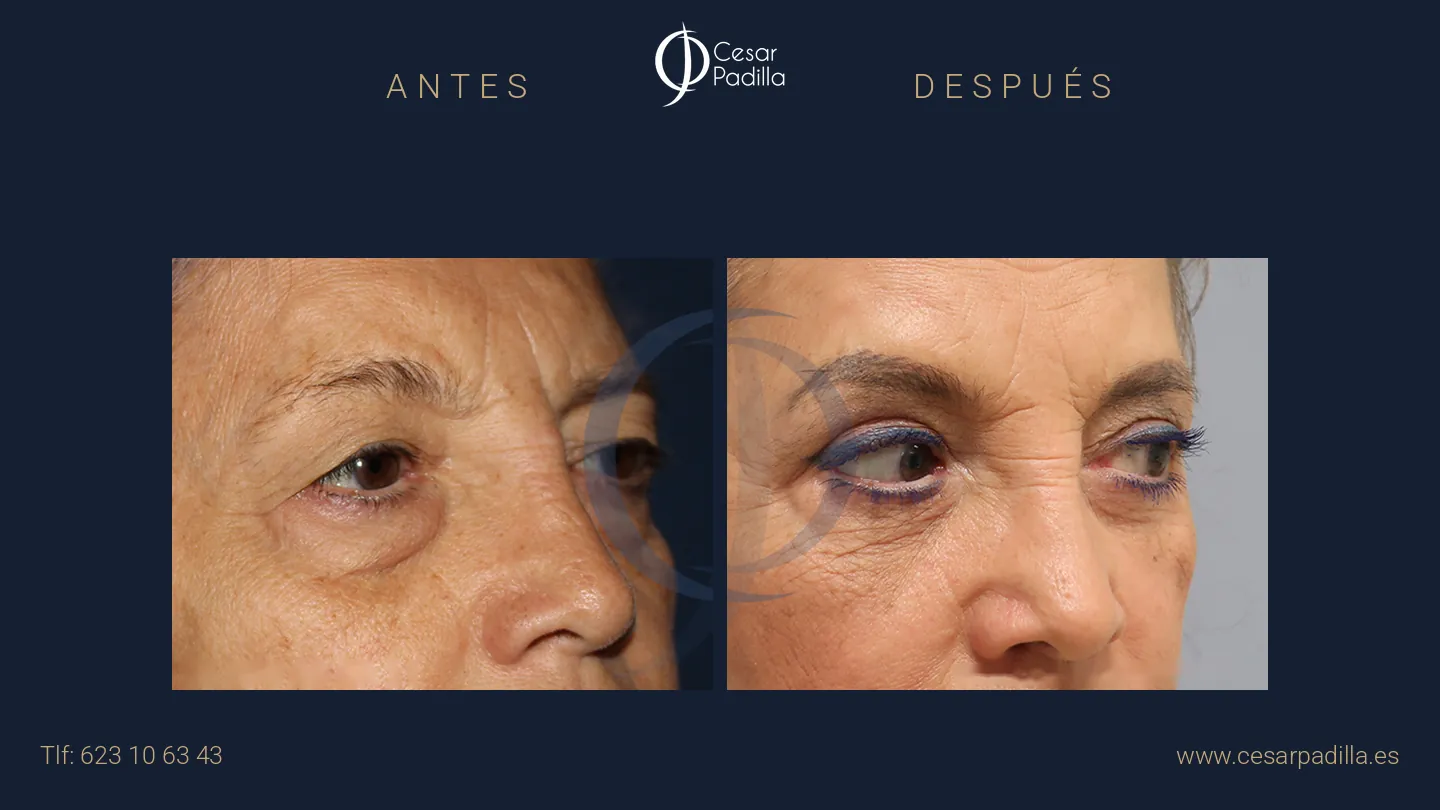 Antes y después de blefaroplastia, caso 12