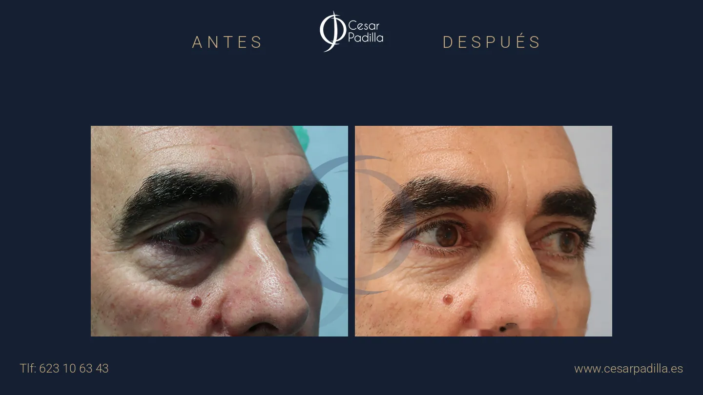 Antes y después de blefaroplastia, caso 13