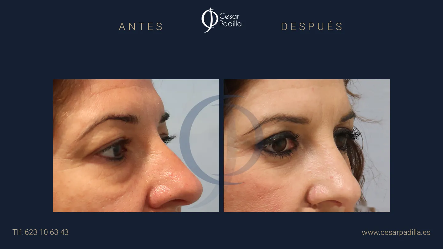 Antes y después de blefaroplastia, caso 14