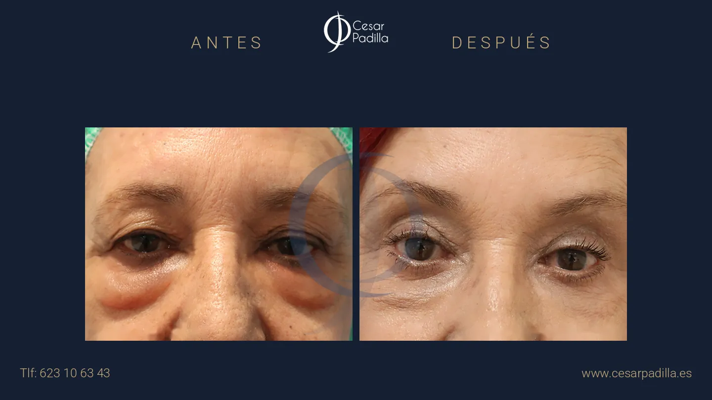 Antes y después de blefaroplastia, caso 2