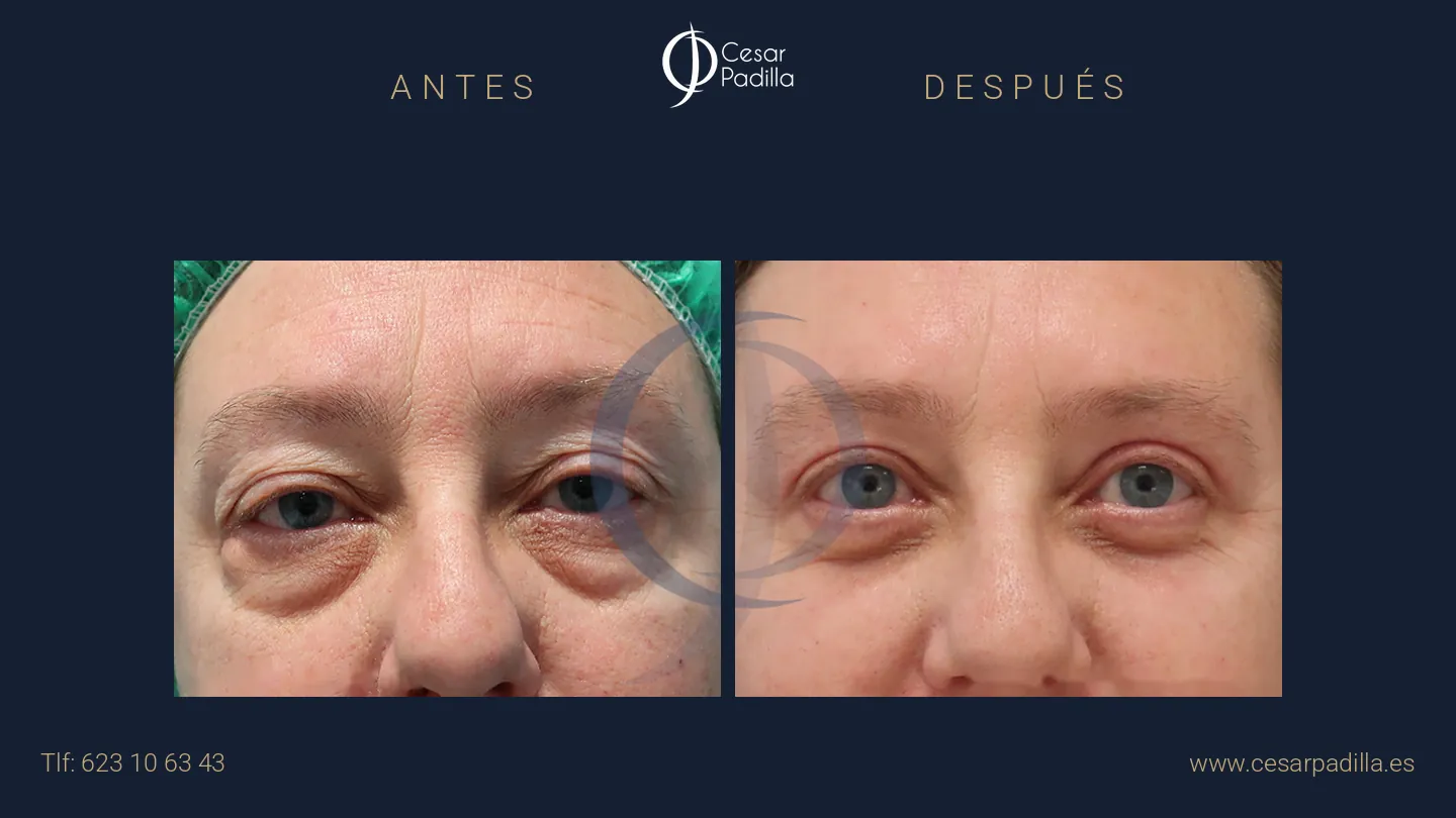 Antes y después de blefaroplastia, caso 3