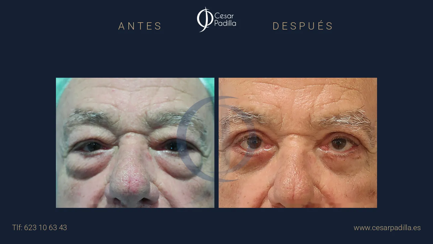 Antes y después de blefaroplastia, caso 4