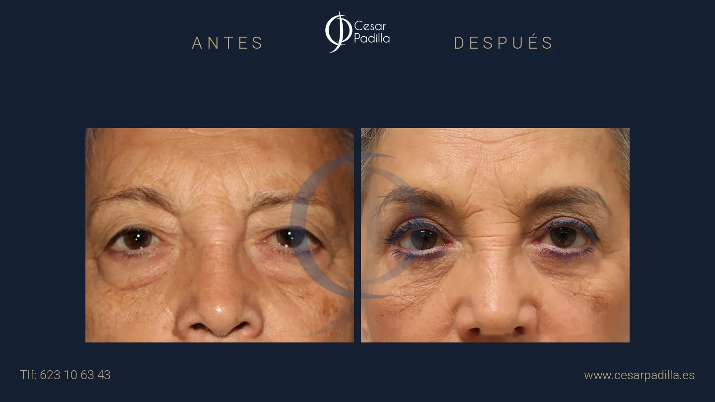 Antes y después de blefaroplastia, caso 5
