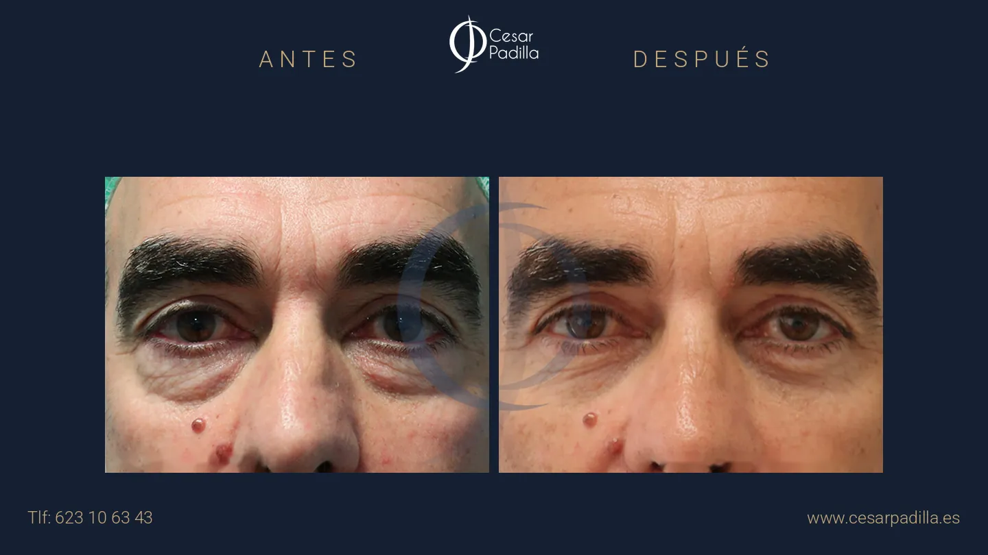 Antes y después de blefaroplastia, caso 6
