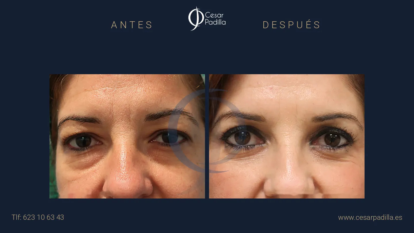 Antes y después de blefaroplastia, caso 7