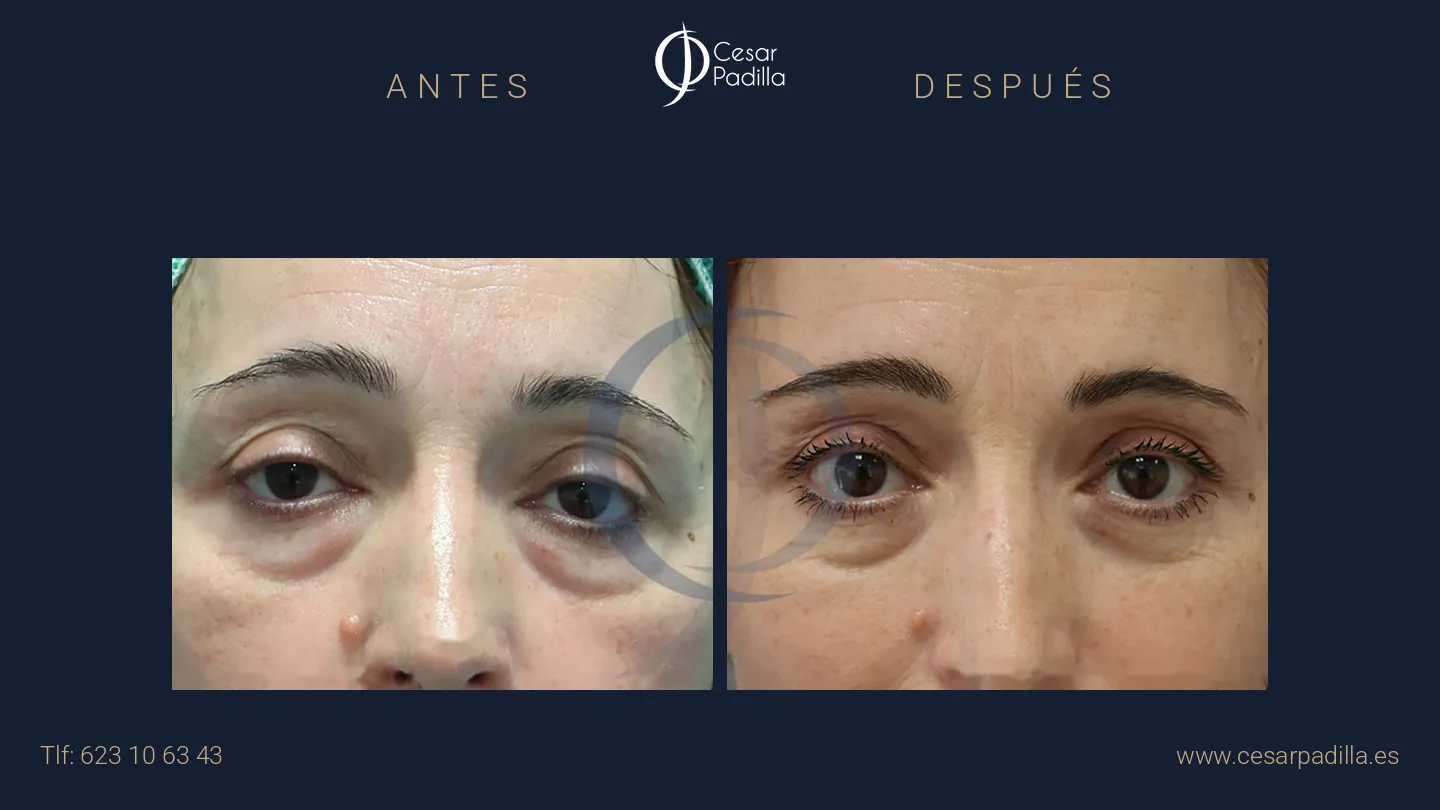 Antes y después de blefaroplastia, caso 8