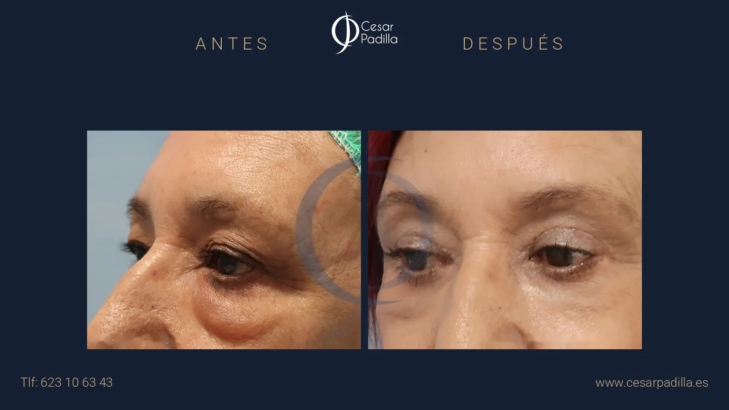 Antes y después de blefaroplastia, caso 9